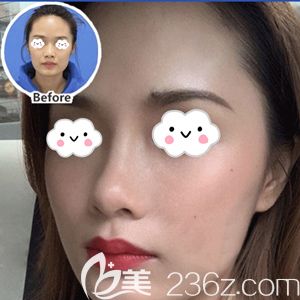 孝感天妃玻尿酸注射術(shù)后對比效果