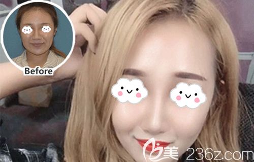 柳肖醫(yī)生做硅膠隆鼻術(shù)后45天鼻形自然