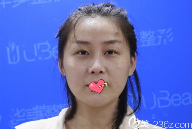 隆鼻失敗后圖片 隆鼻失敗后圖片