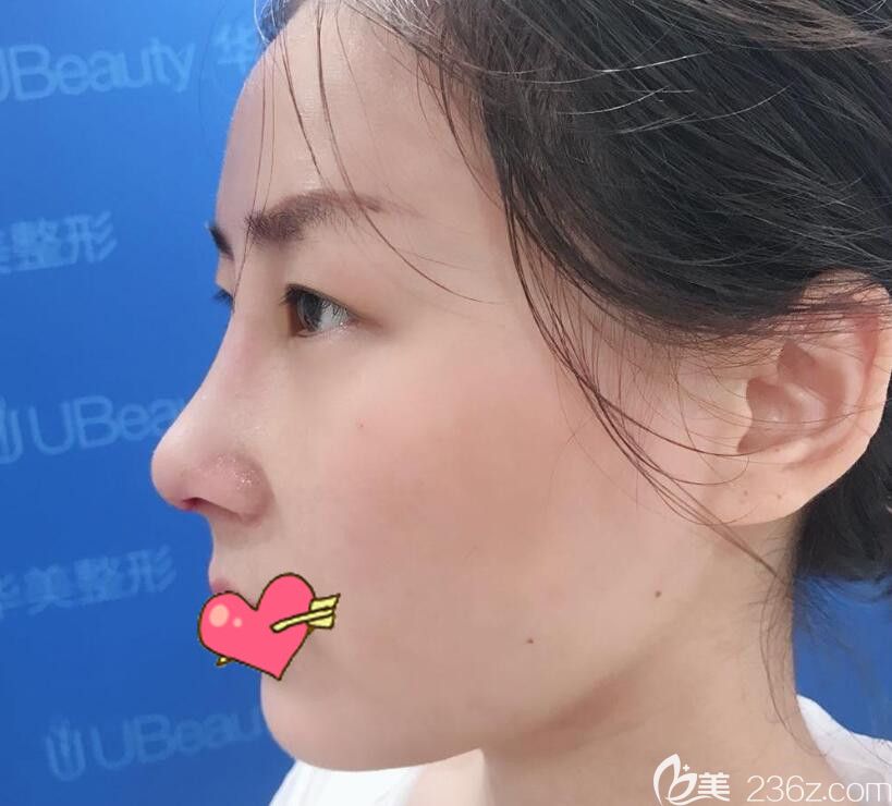 合肥華美整形鼻部失敗修復(fù)術(shù)后第7天拆線后照片 合肥華美整形鼻部失敗修復(fù)術(shù)后第7天拆線后照片