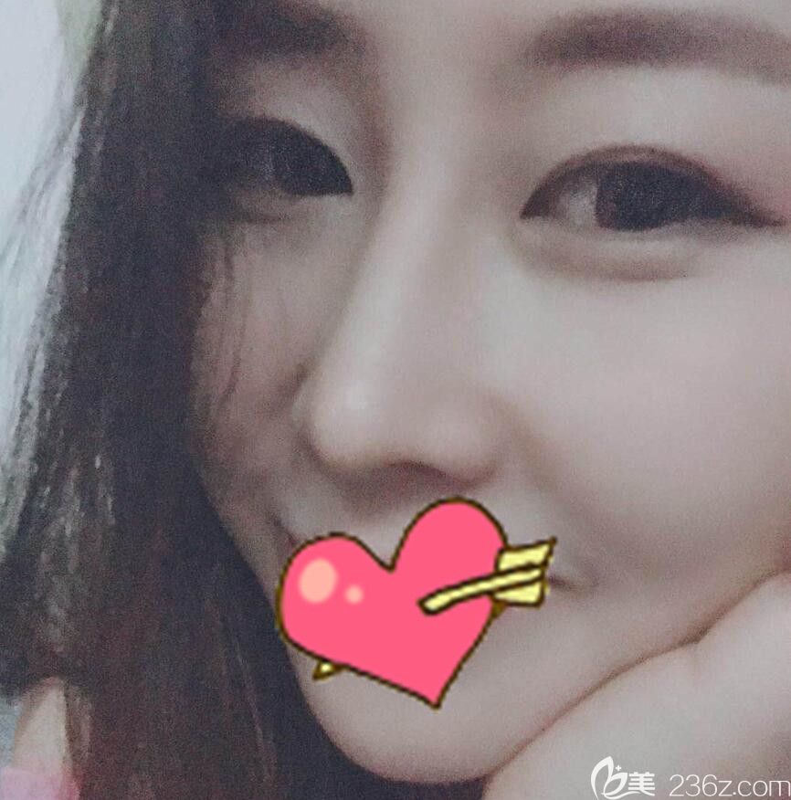 假體隆鼻失敗后我找合肥華美整形楊瑞做了隆鼻失敗修復，附上恢復過程照