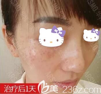 皮秒祛雀斑術(shù)后第1天效果情況 皮秒祛雀斑術(shù)后第1天效果情況