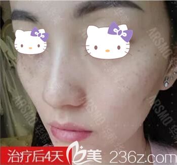 在華韓華美做皮秒祛雀斑術(shù)后4天效果 在華韓華美做皮秒祛雀斑術(shù)后4天效果