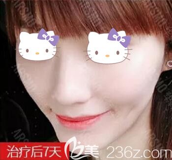 在長沙做皮秒祛雀斑術(shù)后7天情況 在長沙做皮秒祛雀斑術(shù)后7天情況