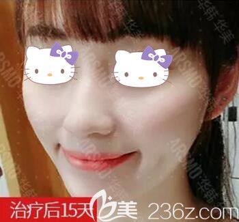 用皮秒治療雀斑術(shù)后15天情況 用皮秒治療雀斑術(shù)后15天情況