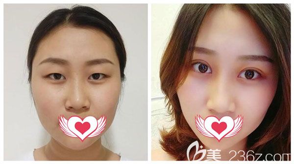 楊繼紅急速納米電眼真實案例效果對比圖