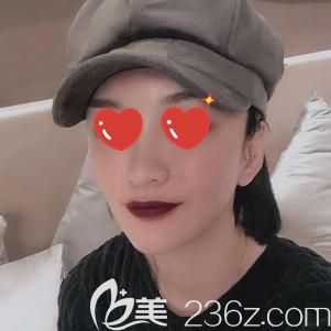 做自體脂肪面部填充術后15天腫脹消除面部飽滿