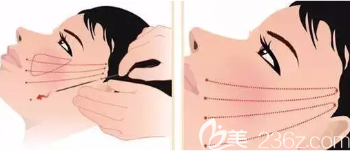 面部埋線提升示例圖