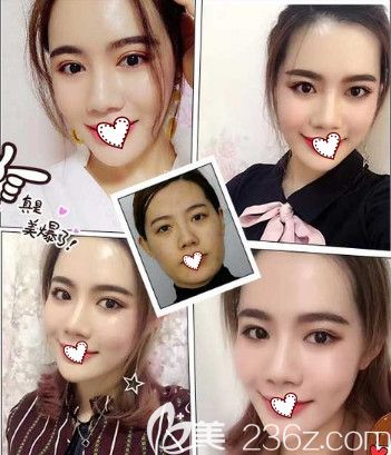 藍(lán)山整形做脂肪填充面部案例