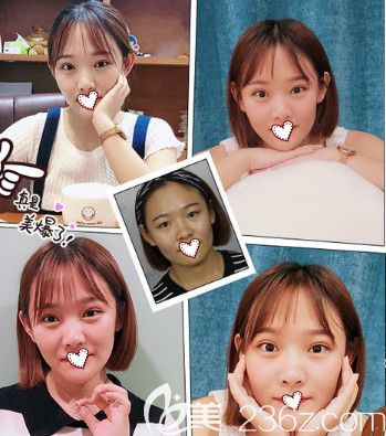 石家莊藍(lán)山做雙眼皮案例