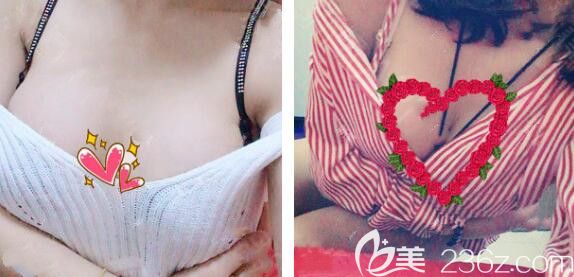 45天前我找合肥藝星整形孫洋做了曼托水滴270cc假體隆胸，小花們覺得我的術后效果怎么樣