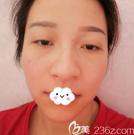 在廣州海峽做眼綜合術(shù)前照片 在廣州海峽做眼綜合術(shù)前照片