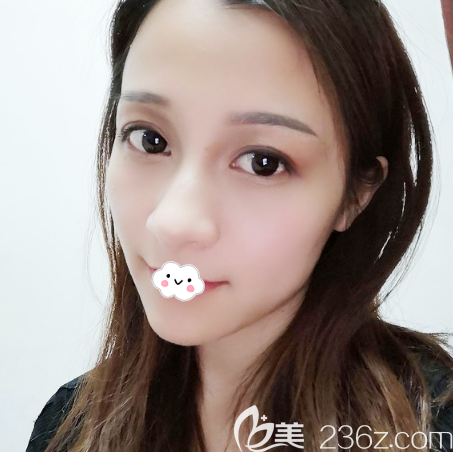 雙眼皮眼綜合術(shù)后15天 雙眼皮眼綜合術(shù)后15天