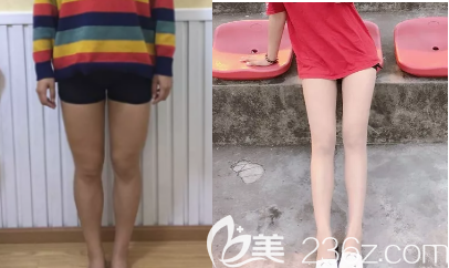 吸脂瘦大腿的術(shù)前術(shù)后照片對比