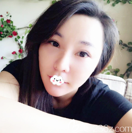 找廣州星團(tuán)醫(yī)美廖均平做完童顏線雕埋線提升后,不僅臉變立體飽滿了皮膚也越來(lái)越緊致了