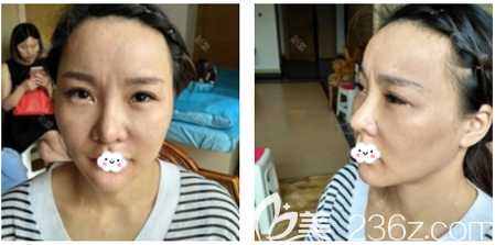 在廣州星團(tuán)醫(yī)美做童顏線雕術(shù)前照片 在廣州星團(tuán)醫(yī)美做童顏線雕術(shù)前照片