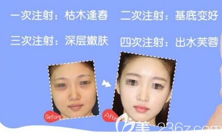 水光注射核心優(yōu)勢