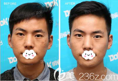 為了幫老婆試試成都銅雀臺(tái)水動(dòng)能祛斑效果，我專(zhuān)門(mén)找楊志宏醫(yī)生給我做了激光祛斑