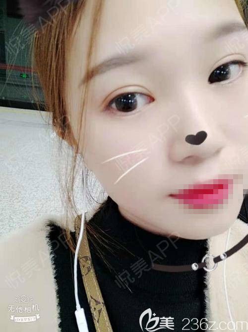 到鄭州醫(yī)德佳體驗(yàn)了一次超贊的蜂巢皮秒祛斑 效果果真名不虛傳