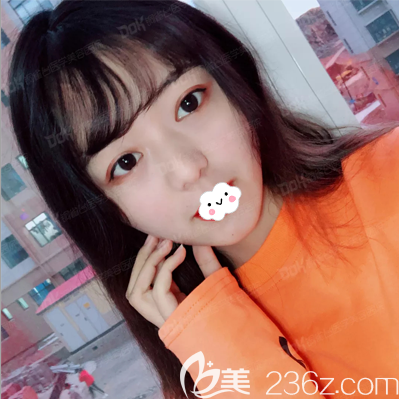 給大家看看我找成都銅雀臺(tái)劉溪做的喜善美眼恢復(fù)過(guò)程，見(jiàn)證我蛻變女神的每個(gè)重要時(shí)刻