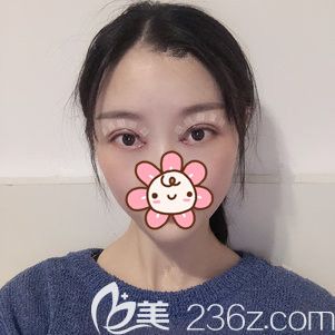 剛做完切開(kāi)重瞼+去皮去脂+開(kāi)眼角術(shù)后即刻效果 剛做完切開(kāi)重瞼+去皮去脂+開(kāi)眼角術(shù)后即刻效果