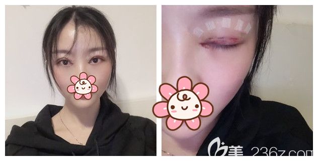 做完切開(kāi)重瞼+去皮去脂+開(kāi)眼角術(shù)后四天恢復(fù)效果 做完切開(kāi)重瞼+去皮去脂+開(kāi)眼角術(shù)后四天恢復(fù)效果