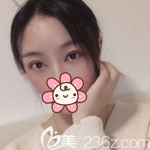 一周拆線以后切開(kāi)重瞼+去皮去脂+開(kāi)眼角恢復(fù) 一周拆線以后切開(kāi)重瞼+去皮去脂+開(kāi)眼角恢復(fù)