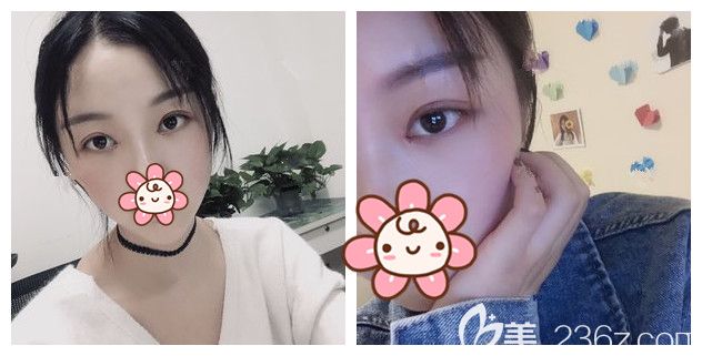 切開(kāi)重瞼+去皮去脂+開(kāi)眼角術(shù)后20天效果 切開(kāi)重瞼+去皮去脂+開(kāi)眼角術(shù)后20天效果