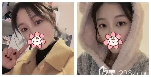 什么是眼綜合?為什么同樣面診南京華韓奇致醫(yī)生閨蜜只用做埋線雙眼皮，而我要做切開重瞼+去皮去脂+開眼角