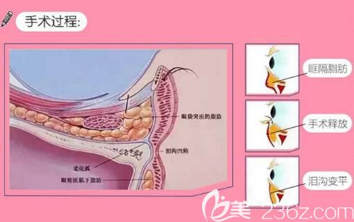 眶隔脂肪釋放祛眼袋