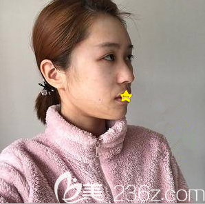 我在北京京韓做全臉脂肪填充第5天樣子