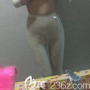 剛做完大腿吸脂術(shù)后穿著塑身衣 剛做完大腿吸脂術(shù)后穿著塑身衣