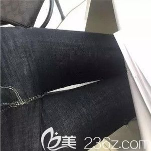 泰州哪里抽脂好?面診泰州華美、麗都、韓術(shù)、奧萊、柏麗等才定下來(lái)在麗都大腿吸脂2000ml目前已經(jīng)術(shù)后10天