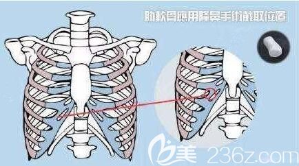 肋軟骨可塑性強(qiáng)