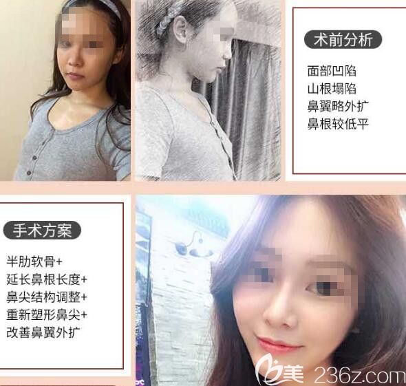 胡斌醫(yī)生肋軟骨隆鼻案例2