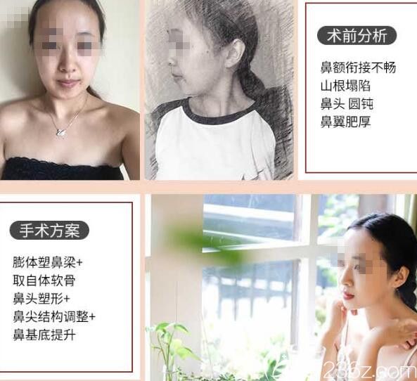 鄭州醫(yī)德佳肋軟骨隆鼻案例