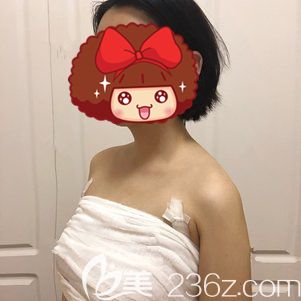 朱勝軍醫(yī)生幫我做自體脂肪隆胸術(shù)后5天胸部飽滿 朱勝軍醫(yī)生幫我做自體脂肪隆胸術(shù)后5天胸部飽滿