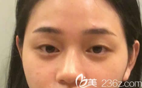 做雙眼皮和開眼角之前 做雙眼皮和開眼角之前