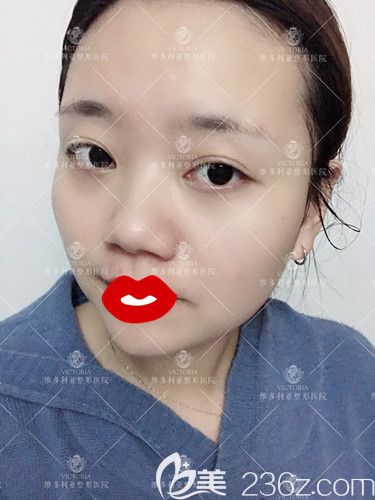 在張家口維多利亞做脂肪填充面部術(shù)前整體輪廓不好看 在張家口維多利亞做脂肪填充面部術(shù)前整體輪廓不好看