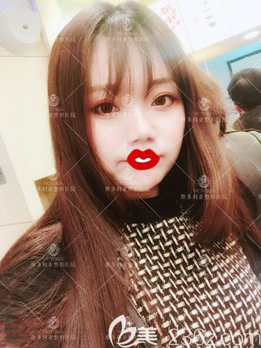 天生大臉在張家口維多利亞做自體脂肪填充后使我擁有精致立體上鏡臉 面部沒有變大且很假的癥狀