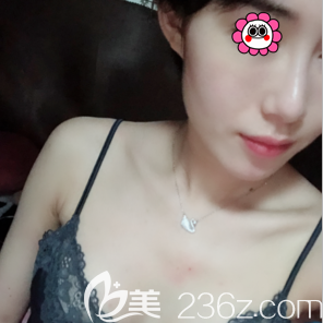 高超醫(yī)生給我做假體內(nèi)窺鏡隆胸第21天樣子 高超醫(yī)生給我做假體內(nèi)窺鏡隆胸第21天樣子