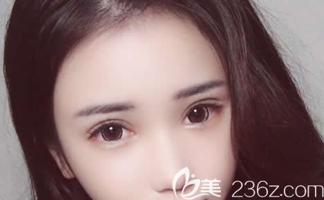 杭州藝星做雙眼皮開眼角30天后 杭州藝星做雙眼皮開眼角30天后