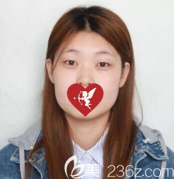 做雙眼皮開眼角眼綜合術(shù)前照 做雙眼皮開眼角眼綜合術(shù)前照