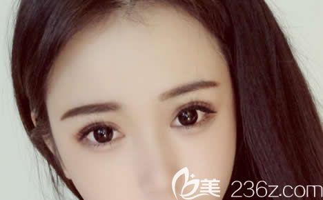 杭州藝星楊連華雙眼皮<span style= 杭州藝星楊連華雙眼皮<span style=