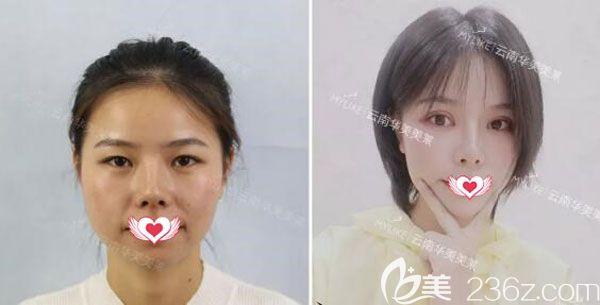 切開雙眼皮+提肌+去脂手術(shù)