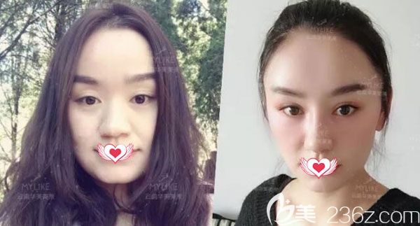 華美美萊做自體脂肪全臉填充案例效果對比圖