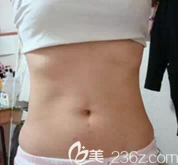 找南寧芯玥整形醫(yī)生做水動(dòng)力腰腹部環(huán)形吸脂一個(gè)月后，成功甩掉“游泳圈”