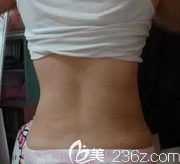 我在南寧美麗星做腰腹部吸脂1個(gè)月