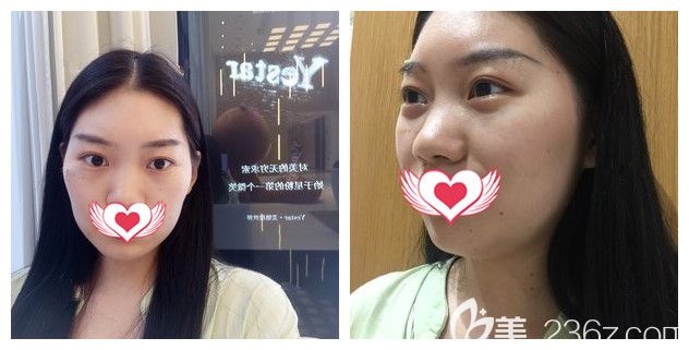 面診南京藝星術(shù)前眼袋明顯面頰凹陷 面診南京藝星術(shù)前眼袋明顯面頰凹陷