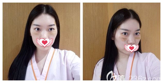 剛做完內(nèi)切法去眼袋術(shù)后恢復(fù) 剛做完內(nèi)切法去眼袋術(shù)后恢復(fù)